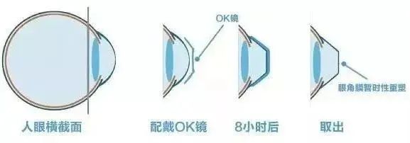 进口医疗器械角膜塑形镜如何报关？